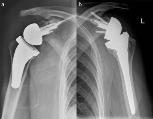 Shoulder Arthroplasty Market