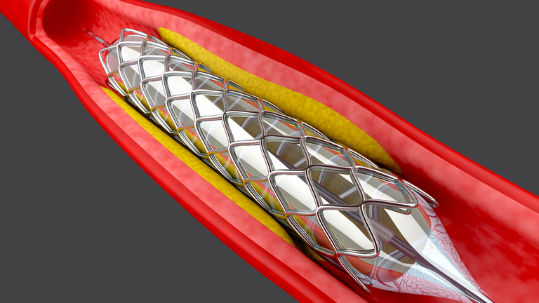Coronary Stents Market Driven by the Rising Number of Surgical Procedures | Abbott, Medtronic, Stentsy SA,