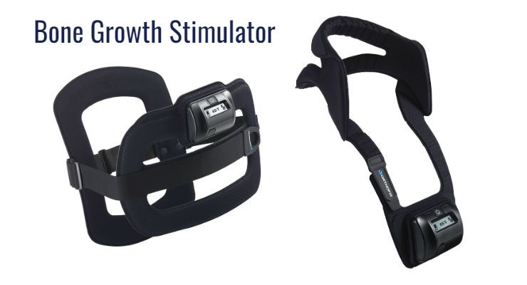 Bone Growth Stimulator Market Size to Worth $ 2,599.7 Mn Booming CAGR Value of 5.6% by 2030 | DJO, Orthofix,