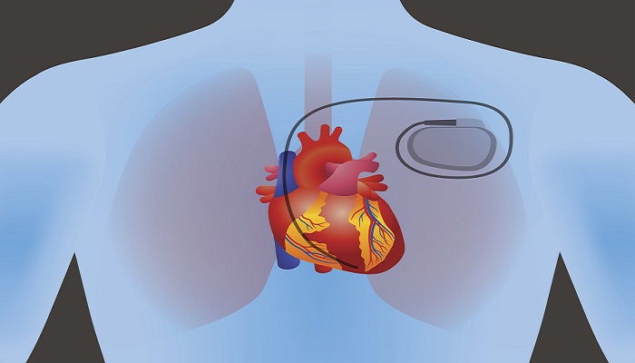 Congestive Heart Failure (CHF) Treatment Devices Market May See A Big ...