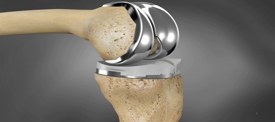 Knee Replacement Devices Market 1