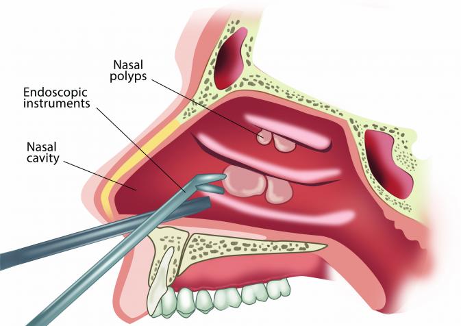Nasal Polyps Treatment Market - Infographics - AMR