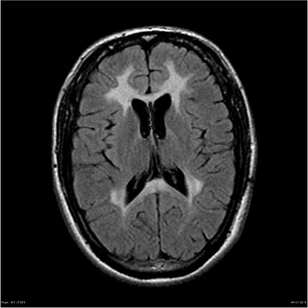 Metachromatic Leukodystrophy Market Size, Trends, Industry Value and ...