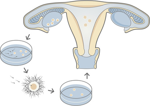 In Vitro Fertilization (IVF) Hormones Market