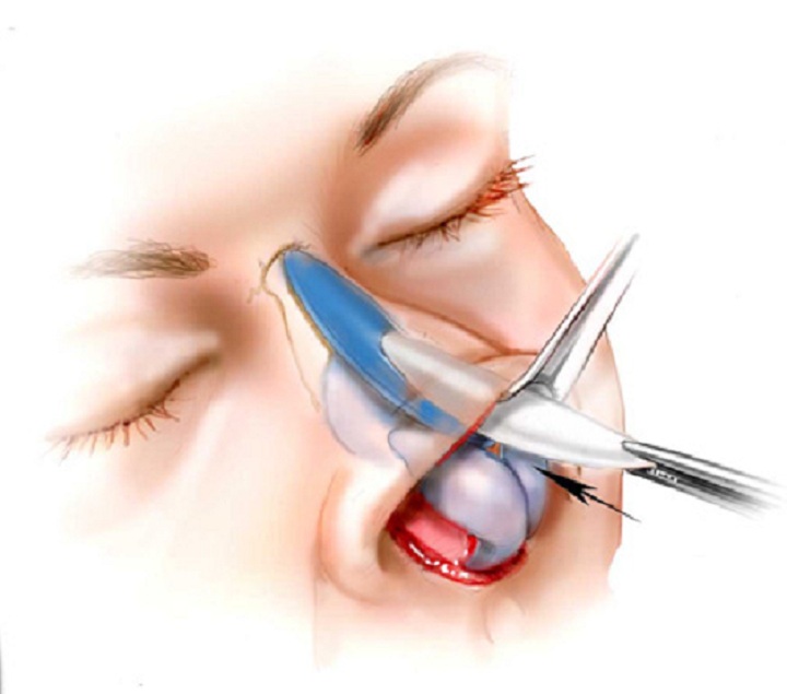 Nasal Implant
