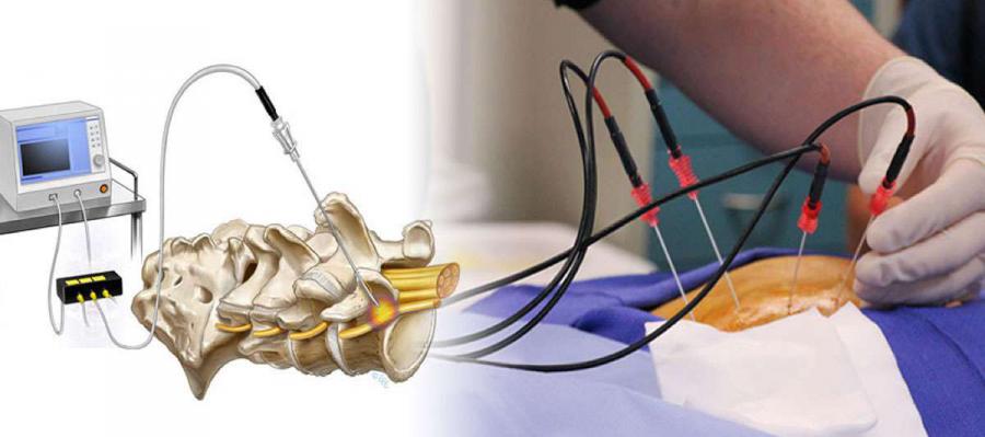 Radiofrequency Ablation Devices Market
