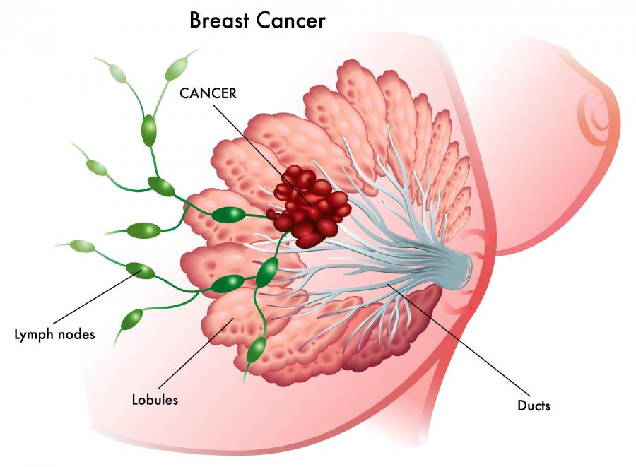 Hormone Breast Cancer