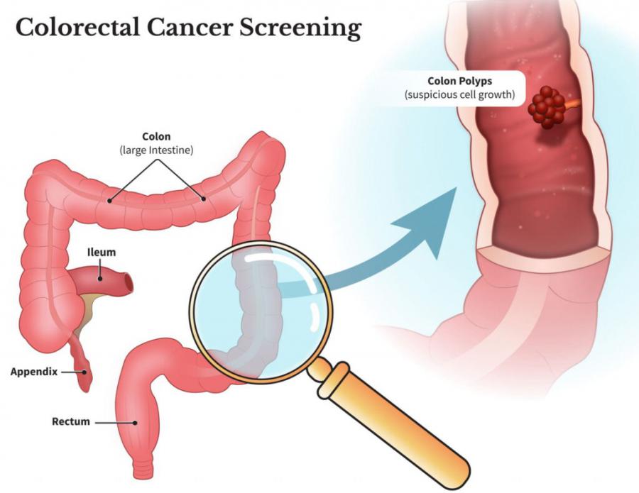 Colorectal Cancer Screening Market 2024