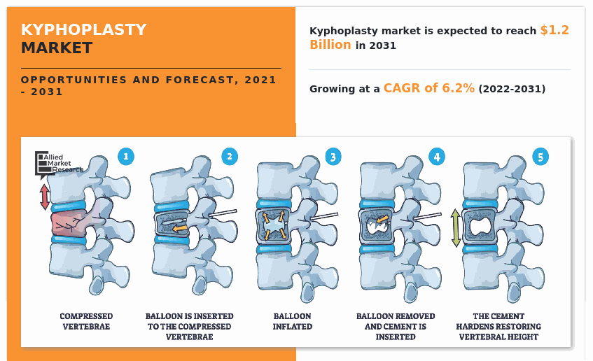 Kyphoplasty Market Guide