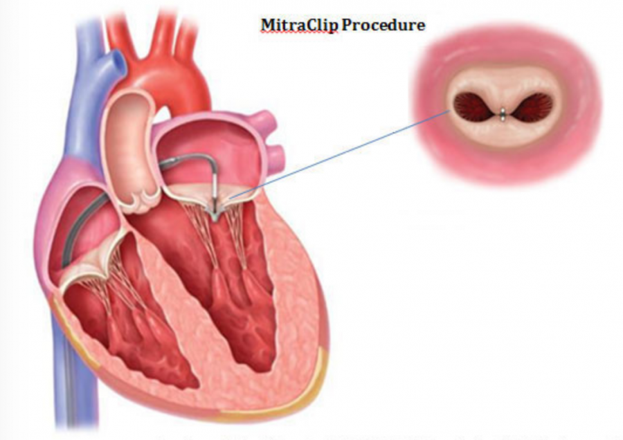 Митральный клапан после операции. Пластика створок митрального клапана. Пластмассовые клапаны сердца. Реконструкция митрального клапана.