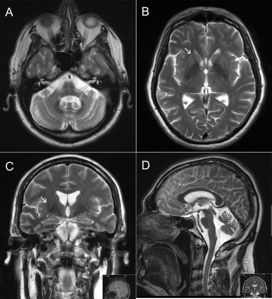 Multiple System Atrophy (MSA) Market