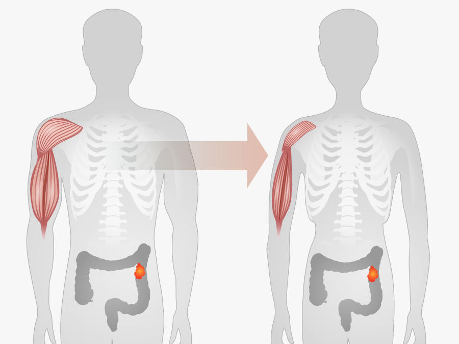 Cancer Cachexia Market 2024-2032