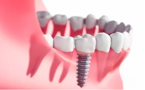 Global Dental Membrane and Bone Graft Substitute Market