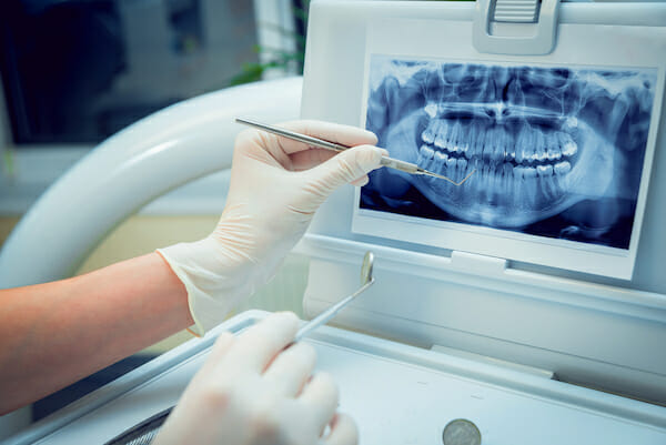 Global Dental Digital X-ray Market