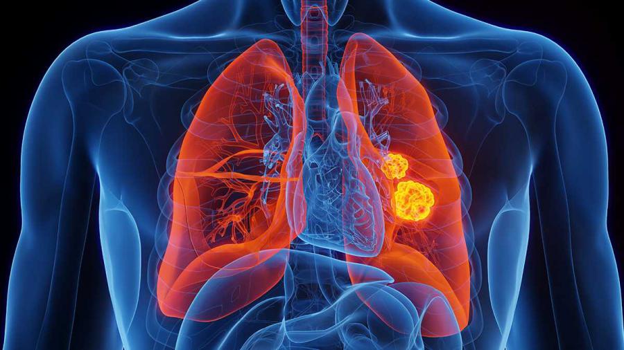 Lung Cancer Surgery Market 2024-2032