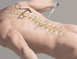 Minimally Invasive Spine Surgery Market 2024-2032