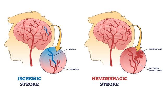 Ischemic Stroke Pipeline Market