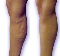 varicose veins before & after treatment examples - Laser Light Treatment Center