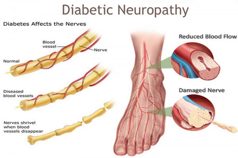 Diabetic Neuropathy Market Research