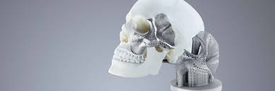 3D Printed Medical Implants Market 2025