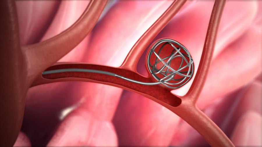 Neuroendovascular Coil Market Witnessing Rising Adoption | Key Players ...