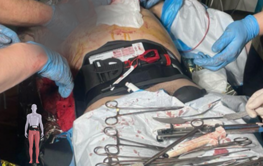 Trauma patient receiving treatment with the AAJT-S tourniquet applied during active resuscitation in a combat environment