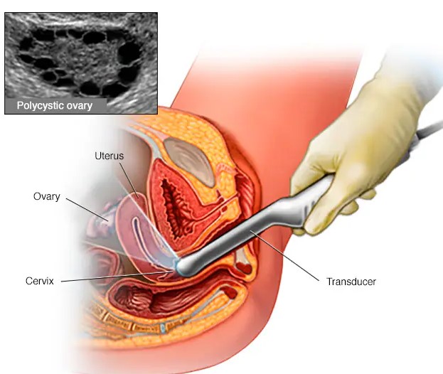 The latest report (2025-2032) on the Polycystic Ovary Syndrome (PCOS) Treatment Market by Coherent Market Insights Provides a deep dive into key market trends, drivers, challenges, and the competitive landscape Polycystic Ovary Syndrome (PCOS) Treatment Market