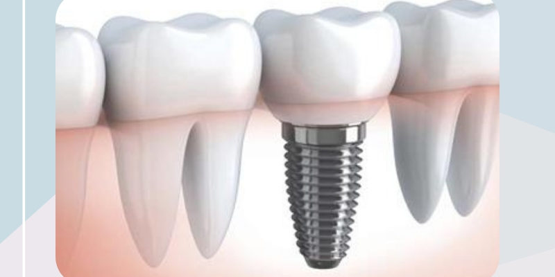 The bio-implant market is estimated to reach USD 146 Bio-Implants
