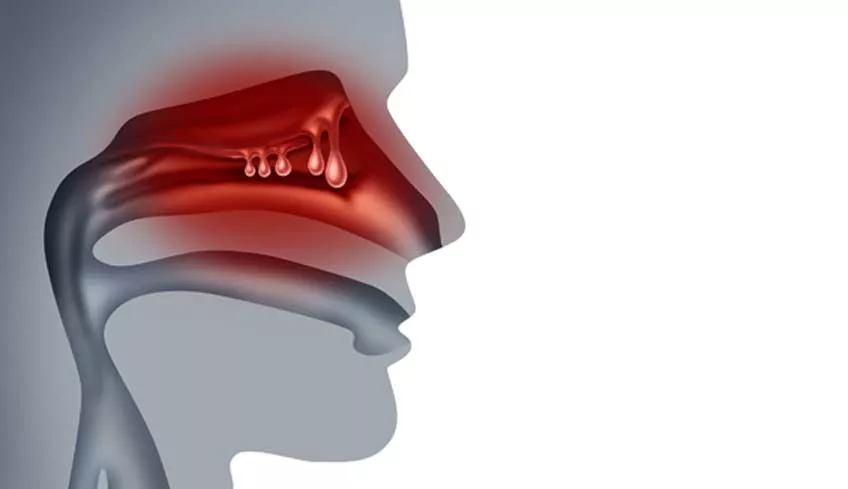 U.S. Nasal Polyps Treatment Market Expands with Biologics & New Indications US Nasal Polyps Treatment Market