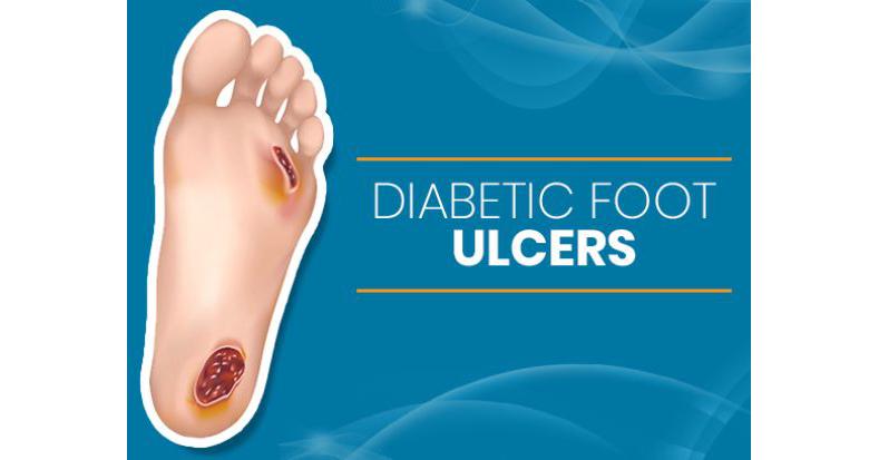 Diabetic Foot Ulcer Market To Grow At A 10.2% Cagr By 2028 