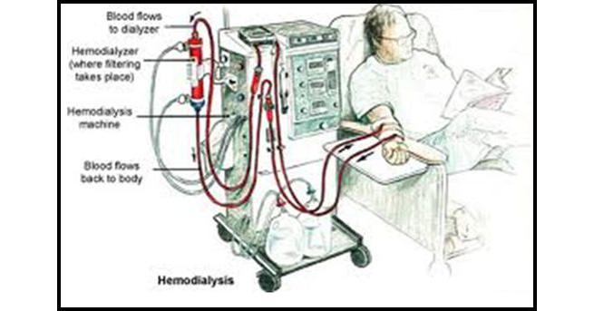 Kidney Dialysis Machine Market to Witness Huge Growth by 2028 | Asahi ...