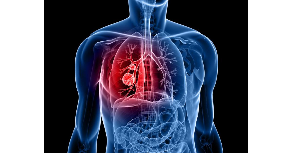 lung-cancer-surgery-market-to-witness-huge-growth-by-2029-accuray