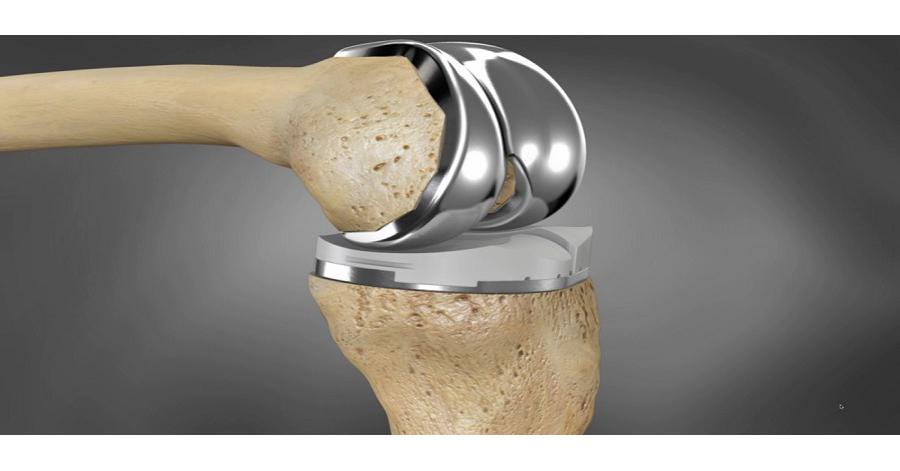 An In-depth Analysis of the Knee Replacement Devices Market: Global ...