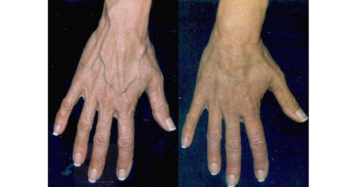 BULGING HAND VEINS PERMANENTLY REMOVED WITH 'REJUVAHANDS TM PROCEDURE.