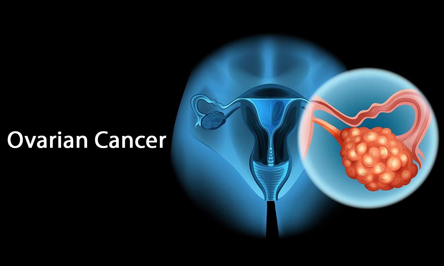 Рак яичников терапия. Онкология яичников наследственные. Онкология яичников у женщин.