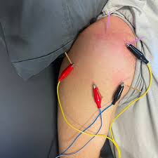 Dry needling