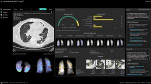 contextflow SEARCH Lung CT user interface