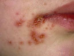 Impetigo Treatment