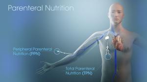 Parenteral Nutrition Market New Study Offers Insights for 2028 Covid-19 Analysis