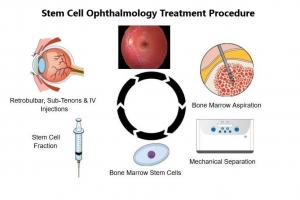 SCOTS2 eye treatment showing bone marrow separation and orbital placement of stem cells