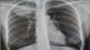 India Idiopathic Pulmonary Fibrosis Treatment Market
