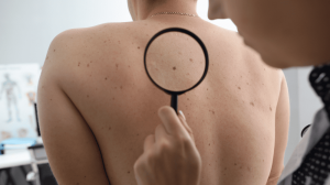 Atlanta urgent care doctor examining skin for skin lesion excision