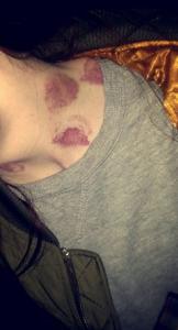 Do hickeys hurt and why are they a bad thing? They only hurt if your partner actually bites down while sucking. The mark is a bruise from broken blood vessels directly under the skin.  I dont think they are bad , perhaps a better way to understand is they