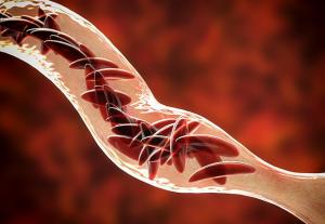 sickle cell disease market