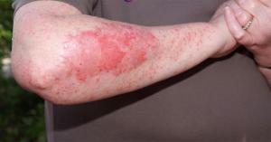 Inflamed itchy skin condition called psoriasis