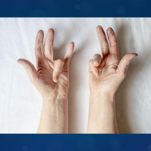 Female Patient with Dupuytren's Contracture (Palmar Fibromatosis)