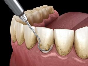 How to Remove Tartar from Teeth