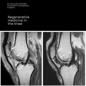 Regenerative Knee Medicine