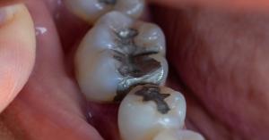 Dental Amalgam Mercury Fillings