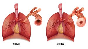 Cannabis CBD Asthma